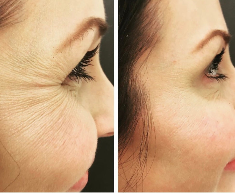 Anti wrinkle treatment 3 areas