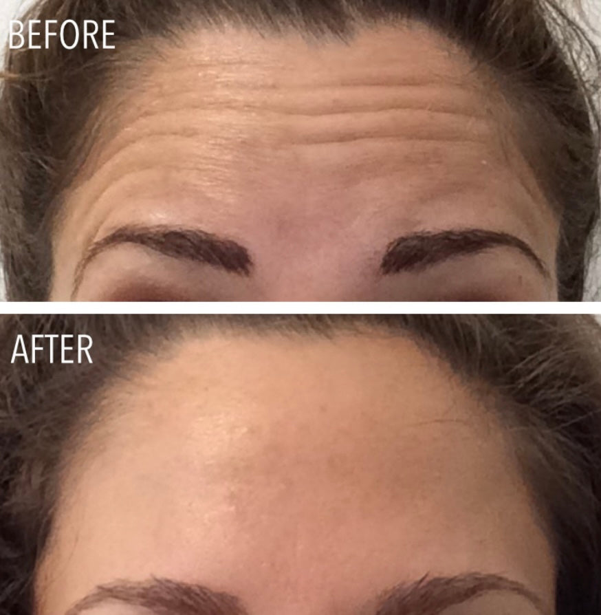 Anti wrinkle treatment 2 areas